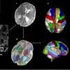 Esto muestra escáneres cerebrales en el período perinatal que resaltan áreas relacionadas con el autismo.